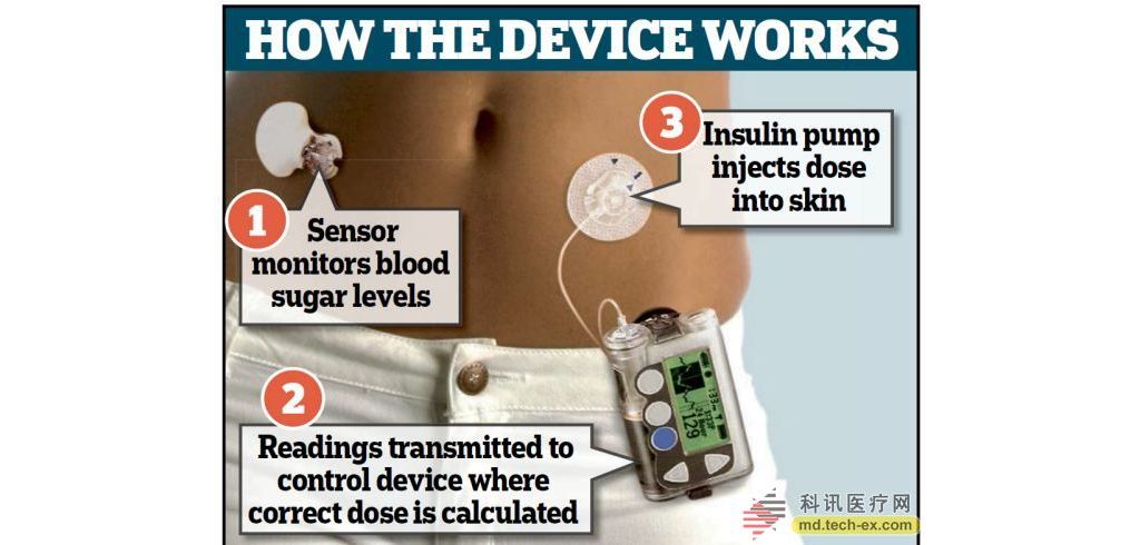 英新式人工胰腺能帮助糖尿病患者精细调控血糖
