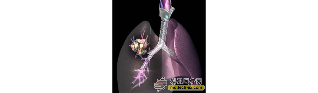 一种针对老年肺癌患者的安全有效的诊断工具