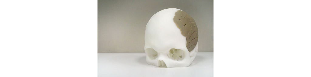3D打印技术打造新低成本头骨置换植入物