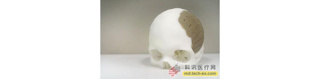 3D打印技术打造新低成本头骨置换植入物