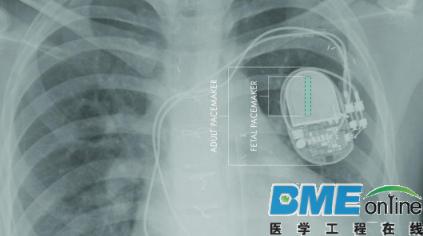 腹中胎儿可以戴着起搏器诞生！