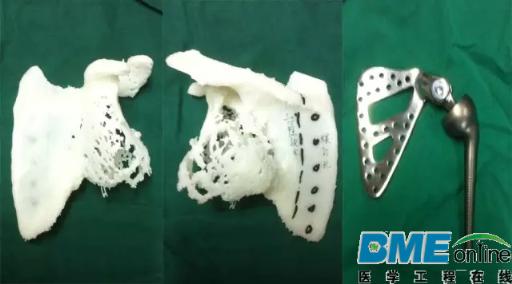 深圳：首次运用3D打印技术为患者换“肩”