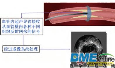苏州医工所在超高频血管内超声换能器及其系统研究中获进展