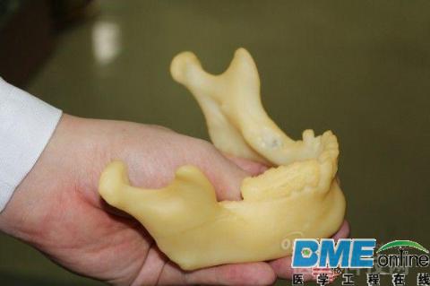 台湾医生用3D打印辅助完成老年患者口腔癌手术