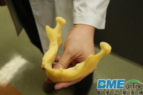 台湾医生用3D打印辅助完成老年患者口腔癌手术