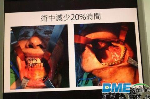 台湾医生用3D打印辅助完成老年患者口腔癌手术