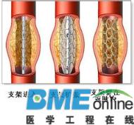 山西省五类高值医用耗材实行限价采购