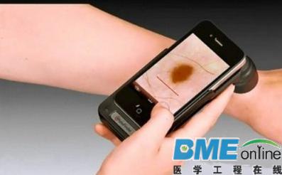 科学家发掘智能手机新作用：可以诊断皮肤癌！