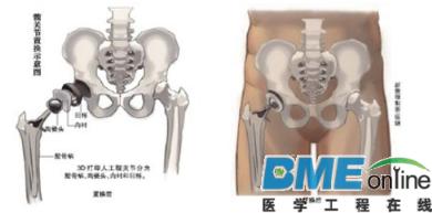3D技术还可以打印人体器官