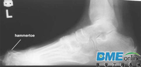 Additive公司研发出医疗3D打印植入物治疗槌状趾