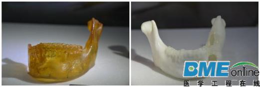 医疗手术案例：用3D打印助力下颌重塑