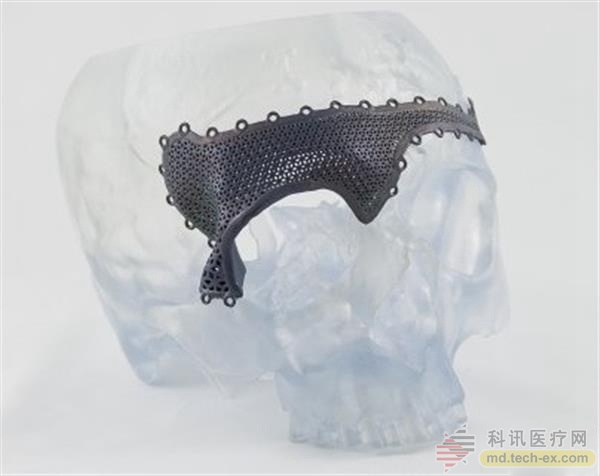 强生子公司在欧洲推出定制化3D打印颌面植入物