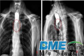 动态DR在食道造影检查中大显神威