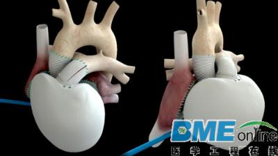 世界第五例永久性人工心脏移植者已去世