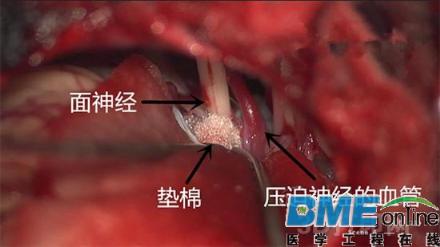 最新研究：3D打印技术可用于肌痉挛微创手术