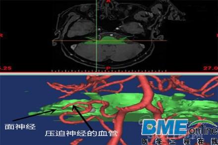 最新研究：3D打印技术可用于肌痉挛微创手术