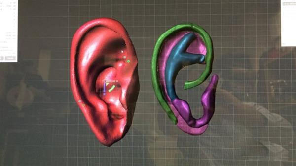 3D打印结合扫描技术让9岁女孩重获新耳