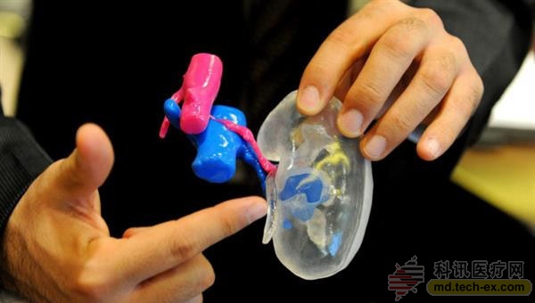 透明3D打印手术模型帮助拯救肿瘤患者肾脏