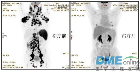 首例多靶点CAR-T细胞治疗恶性淋巴瘤获得成功