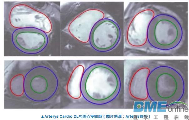 FDA首次批准一款心脏核磁共振影像人工智能分析软件