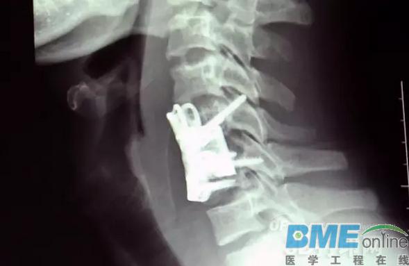 3D打印医学应用：颈椎“换柱”