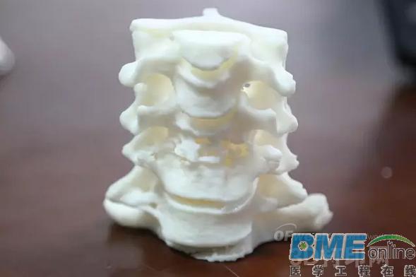3D打印医学应用：颈椎“换柱”