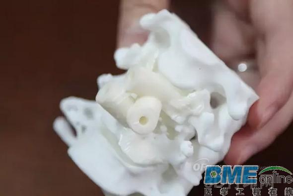 3D打印医学应用：颈椎“换柱”