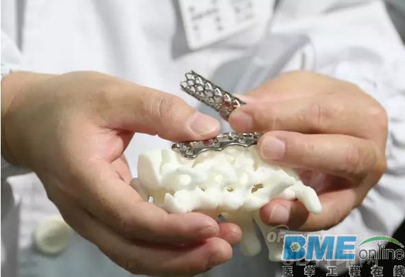 3D打印医学应用：颈椎“换柱”