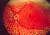 电子人工视网膜助患者复明