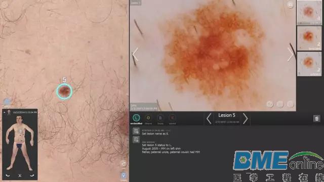 360 3D全身成像系统可捕捉皮肤表面全部损伤