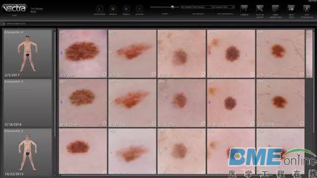 360 3D全身成像系统可捕捉皮肤表面全部损伤