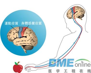 “脑机结合”技术是中风患者的福音：可用意念控制身体