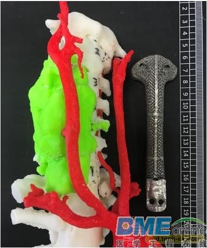 我国专家率先3D打印全颈椎助患者颈椎“再生”