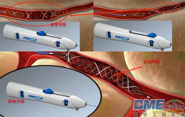 脑卒中治疗有了新突破，Perflow研发出回撤式机械取栓器