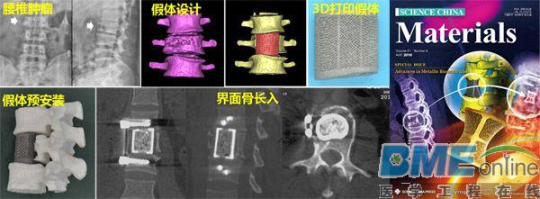 高强韧多孔钛合金人工骨材料研发取得突破