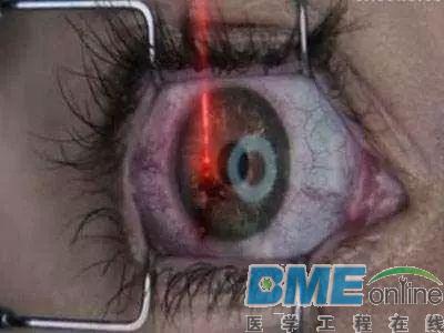 20年过去了，第一批接受近视眼手术的人现在怎么样了？