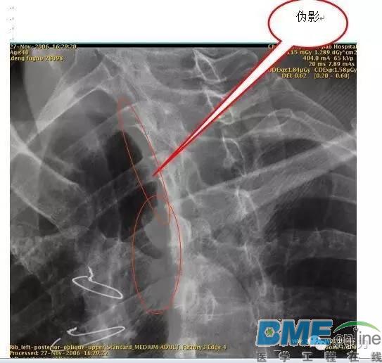 GE Definium(飞天)6000 DR非典型影像伪影案例分析