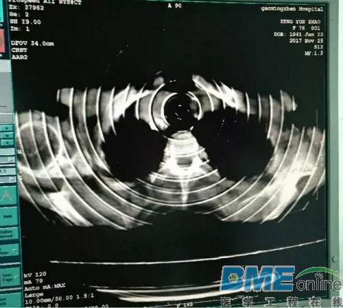 GE CT图像满屏环形伪影，无报错故障维修