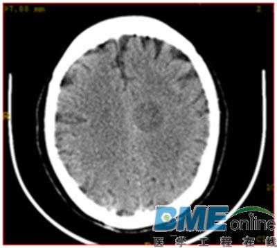 论CT机架清洁的重要性
