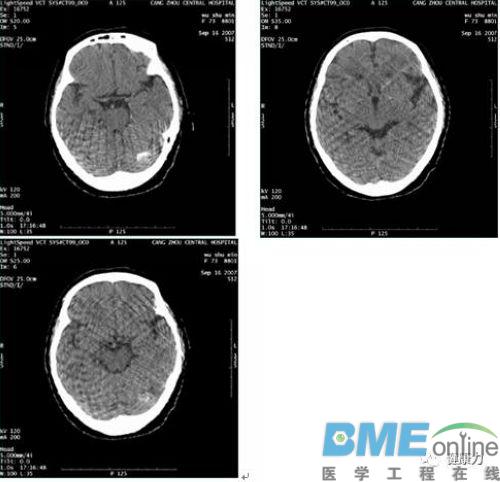 GE Lightspeed VCT间歇性伪影检修
